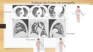 Avaliação dos Cortes em tomografia
Corte axial
Corte sagital
Corte coronal
 