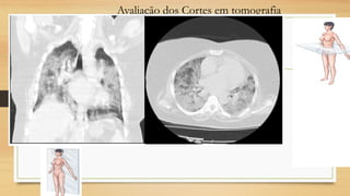 Avaliação dos Cortes em tomografia
Corte axial
Corte sagital
 