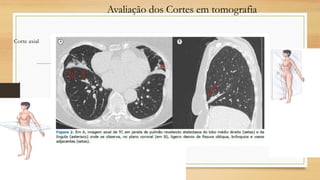 Avaliação dos Cortes em tomografia
Corte axial
Corte sagital
Corte coronal
 