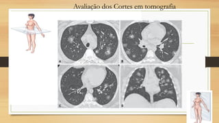 Avaliação dos Cortes em tomografia
 