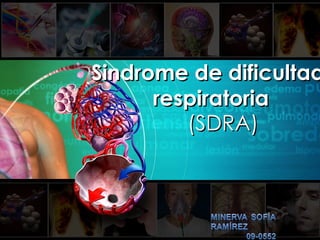Sindrome de dificultad  respiratoria (SDRA) 