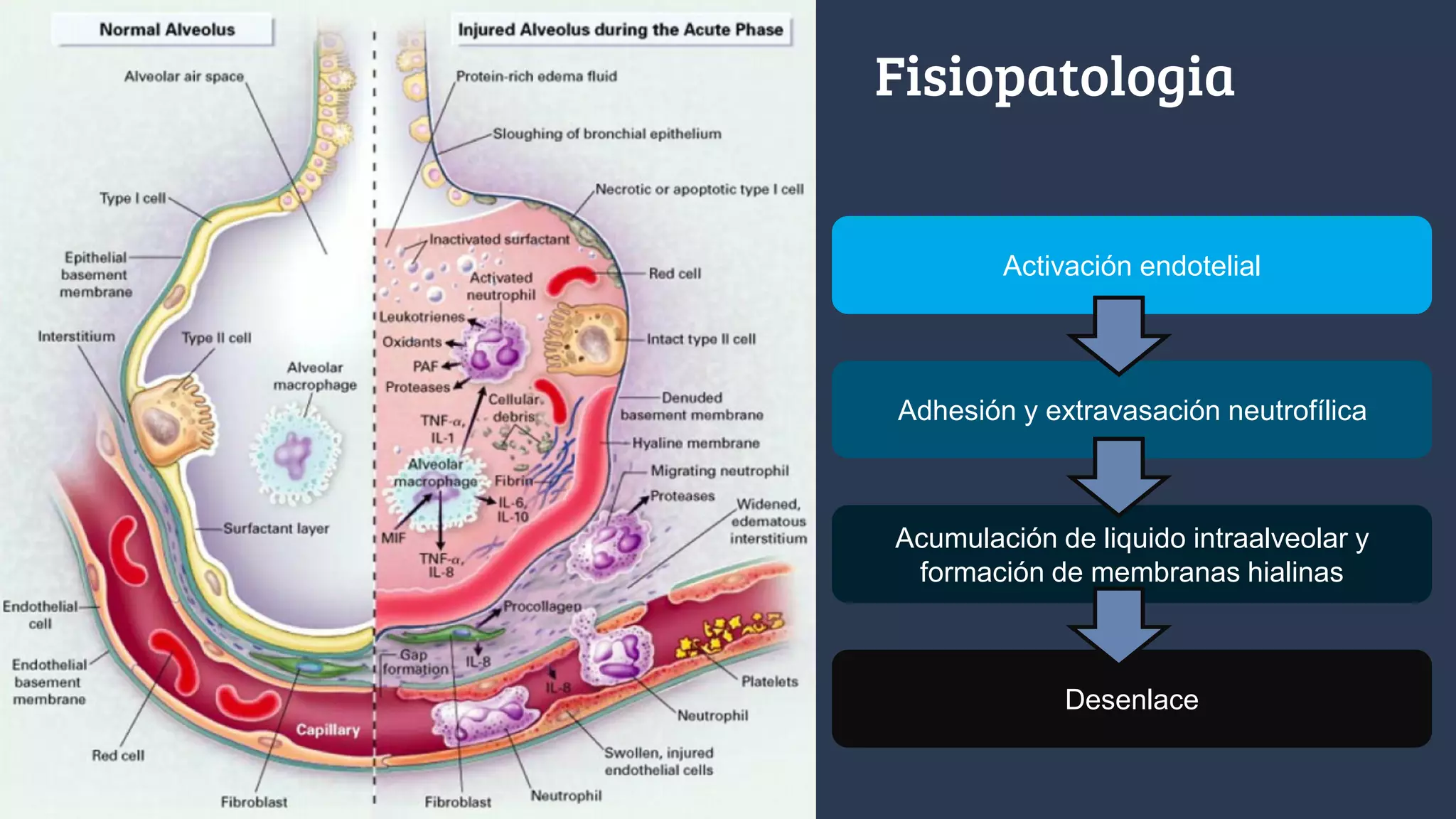 Sindrome de dificultad respiratoria aguda | PDF