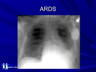 ARDS 