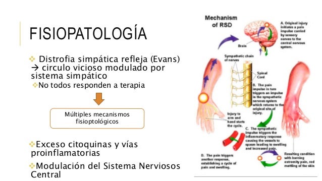 Sindrome Dolor Regional Complejo