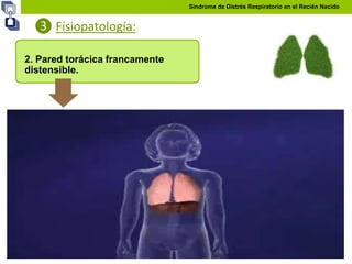 Quite Distensible Distres respiratorio en el NEONATO | PPTX