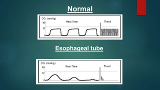 Normal
Esophageal tube
 
