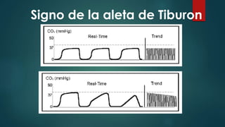 Signo de la aleta de Tiburon
 
