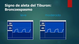 Signo de aleta del Tiburon:
Broncoespasmo
leve moderado
 