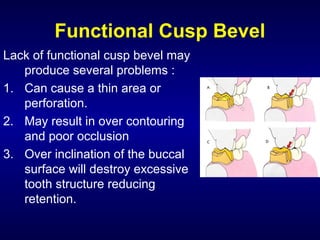 Functional Cusp Bevel
Lack of functional cusp bevel may
   produce several problems :
1. Can cause a thin area or
   perforation.
2. May result in over contouring
   and poor occlusion
3. Over inclination of the buccal
   surface will destroy excessive
   tooth structure reducing
   retention.
 