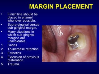 MARGIN PLACEMENT
•    Finish line should be
     placed in enamel
     whenever possible.
•    Supra-gingival versus
     sub-gingival margin.
•    Many situations in
     which sub-gingival
     margins are
     unavoidable.
1.   Caries
2.   To increase retention
3.   Esthetics
4.   Extension of previous
     restoration
5.   Trauma.
 