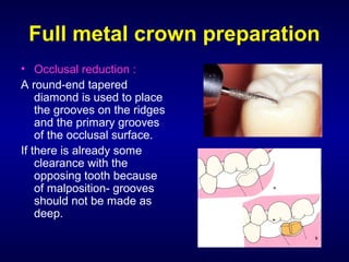 Full metal crown preparation
• Occlusal reduction :
A round-end tapered
    diamond is used to place
    the grooves on the ridges
    and the primary grooves
    of the occlusal surface.
If there is already some
    clearance with the
    opposing tooth because
    of malposition- grooves
    should not be made as
    deep.
 