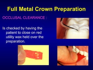 Full Metal Crown Preparation
OCCLUSAL CLEARANCE :

Is checked by having the
   patient to close on red
   utility wax held over the
   preparation.
 
