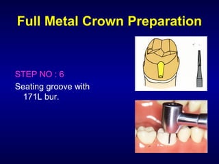 Full Metal Crown Preparation


STEP NO : 6
Seating groove with
  171L bur.
 