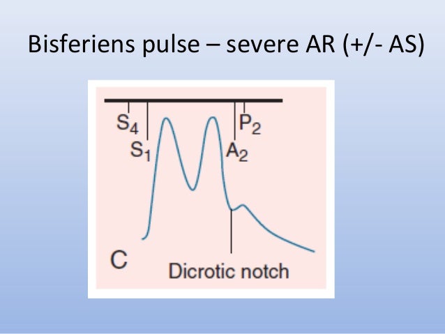 Bisferiens pulse in aortic regurgitation