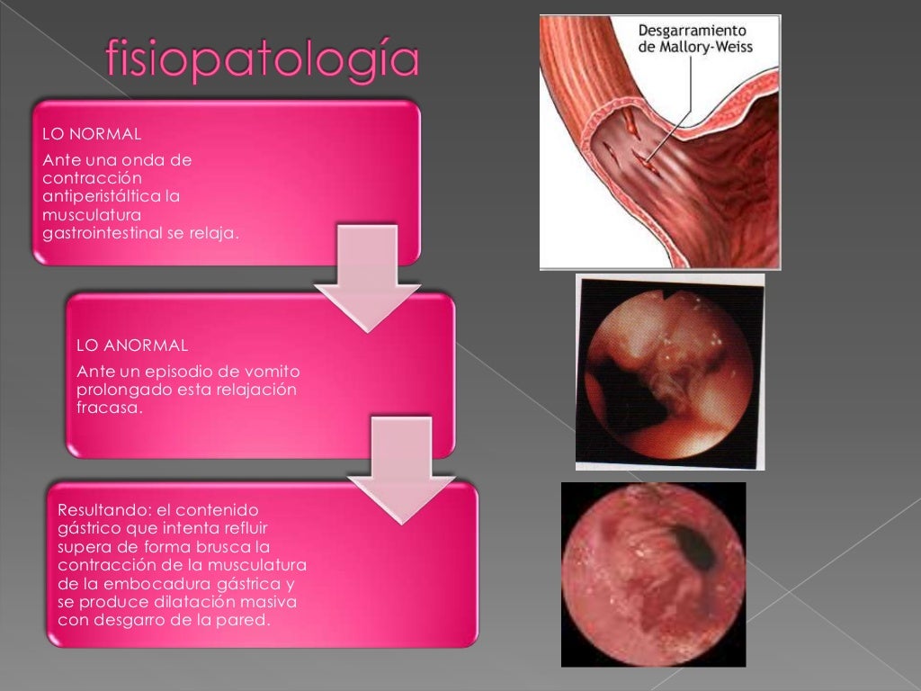 Sangrado de Tubo Digestivo Alto