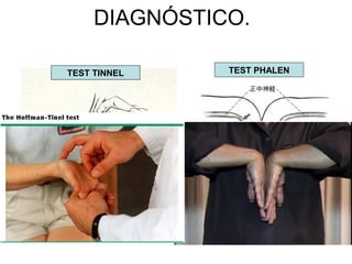 DIAGNÓSTICO.
TEST TINNEL TEST PHALEN
 
