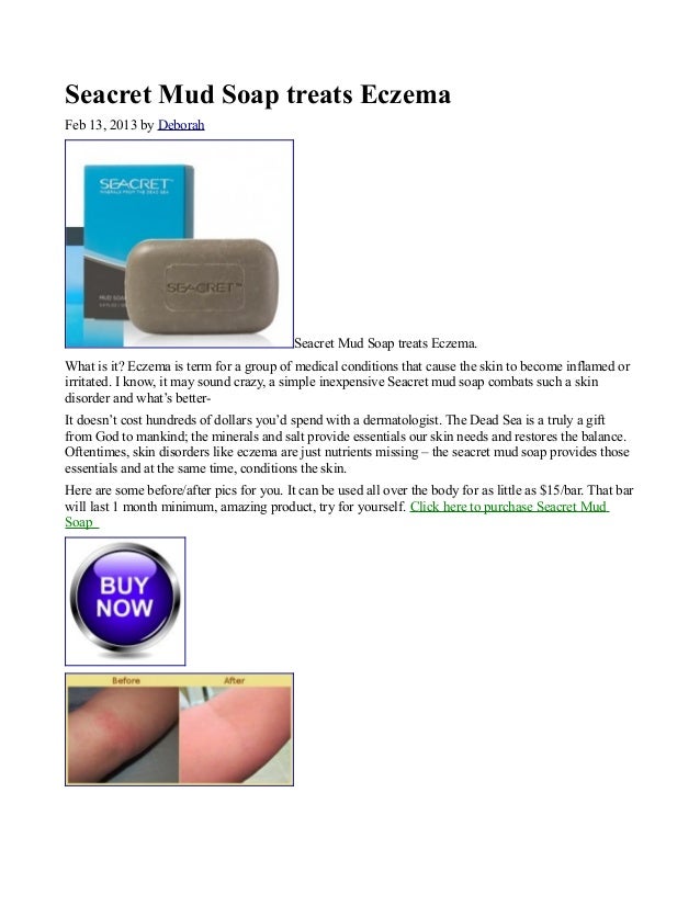 Seacret Mud Soap treats Eczema