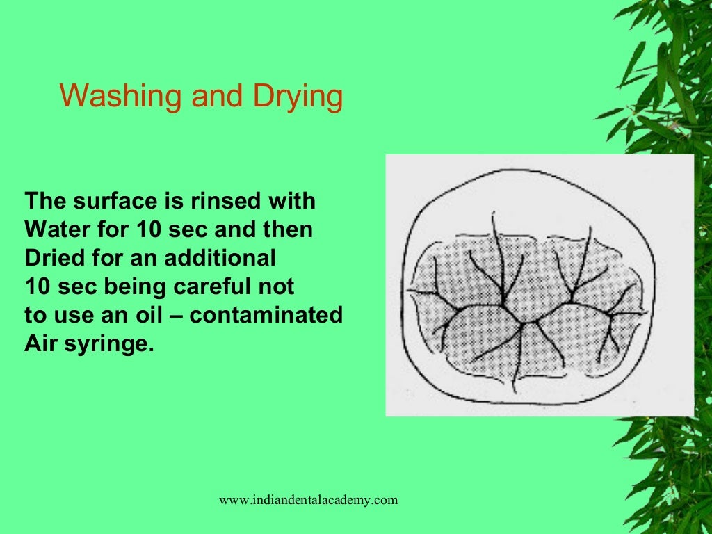 Sealants & preventive resin restorations / dental courses