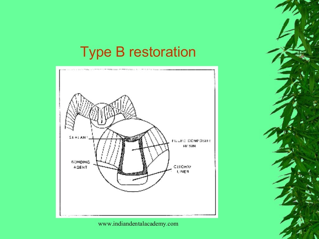 Sealants & preventive resin restorations / dental courses