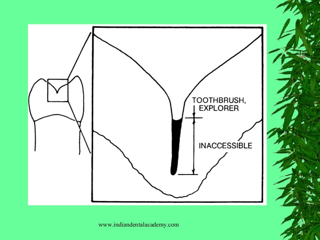 Sealants & preventive resin restorations / dental courses