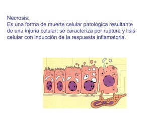 Necrosis:  Es una forma de muerte celular patológica resultante de una injuria celular; se caracteriza por ruptura y lisis celular con inducción de la respuesta inflamatoria. 
