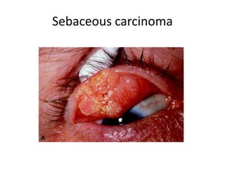 Variants
• Basaloid sebaceous carcinoma
Small cells with scant cytoplasm, nuclear palisading
Manifests as Grade III with s...