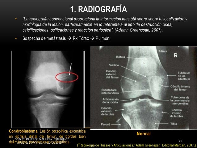lesiones tumorales de extremidad superior e inferior