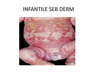 INFANTILE SEB DERM
 
