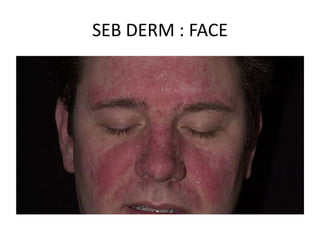 SEB DERM : FACE
 