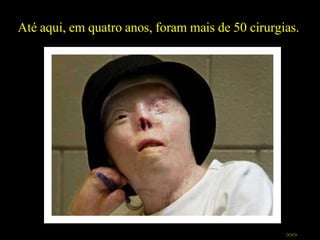 Até aqui, em quatro anos, foram mais de 50 cirurgias.  >>> 