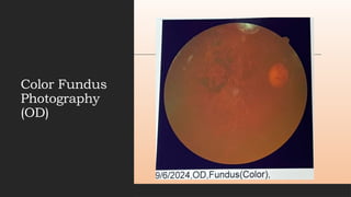 Color Fundus
Photography
(OD)
 