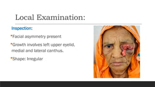 Local Examination:
Inspection:
Facial asymmetry present
Growth involves left upper eyelid,
medial and lateral canthus.
Shape: Irregular
 