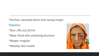 Surface: ulcerated lesion with oozing margin
Palpation:
Size: (30⨉12⨉2)mm
Base :Fixed with underlying structure
Margin: Irregular
Mobility: Non-mobile
 
