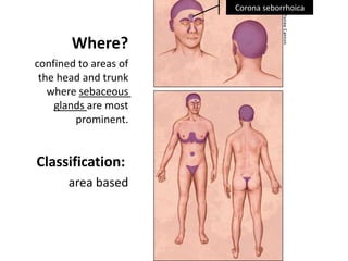 Corona seborrhoica

Where?
confined to areas of
the head and trunk
where sebaceous
glands are most
prominent.

Classification:
area based

 