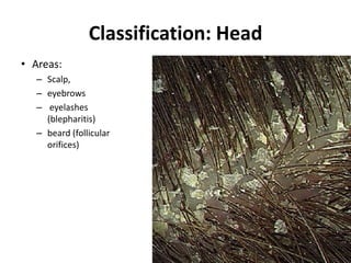 Classification: Head
• Areas:
– Scalp,
– eyebrows
– eyelashes
(blepharitis)
– beard (follicular
orifices)

 