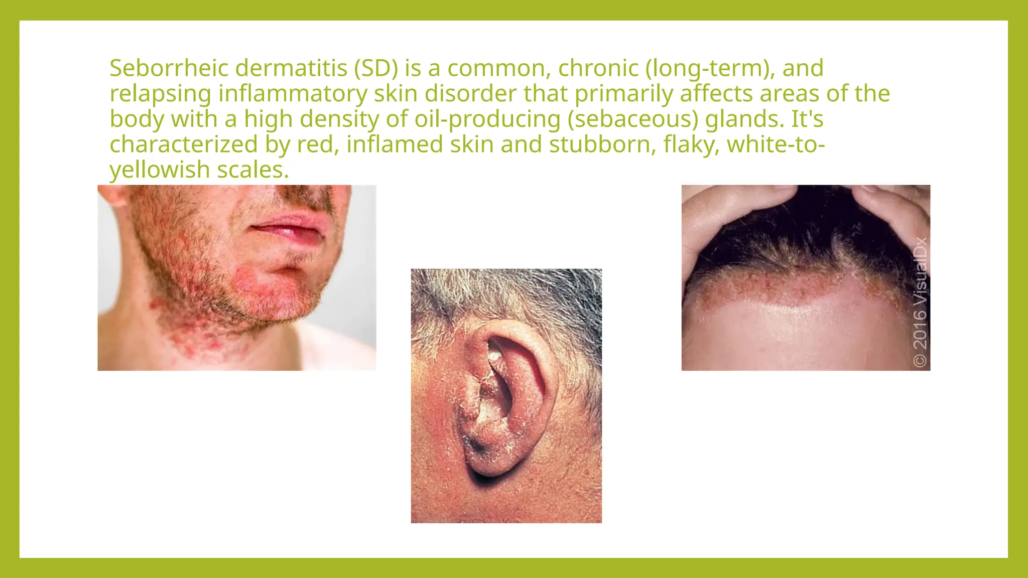 Serboric Derma Seborrheic dermatitis causes and treatments.pptx