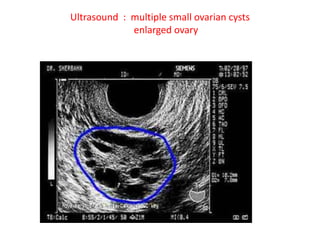 Ultrasound : multiple small ovarian cysts
enlarged ovary
 