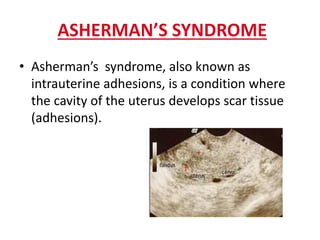ASHERMAN’S SYNDROME
• Asherman’s syndrome, also known as
intrauterine adhesions, is a condition where
the cavity of the uterus develops scar tissue
(adhesions).
 
