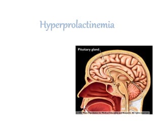Hyperprolactinemia
 