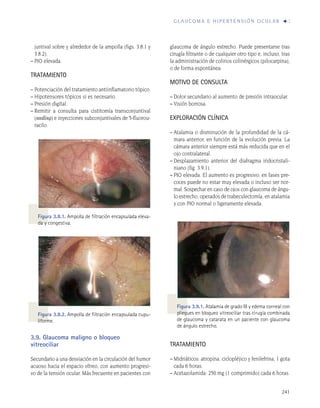 Sección 6. glaucoma e hipertensión ocular | PDF