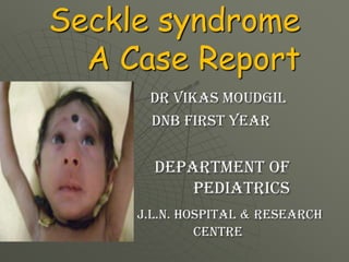 Seckle syndrome
  A Case Report
      dr vikas moudgil
      DNB FIRST YEAR


       Department of
           pediatrics
     J.L.N. Hospital & research
              centre
 