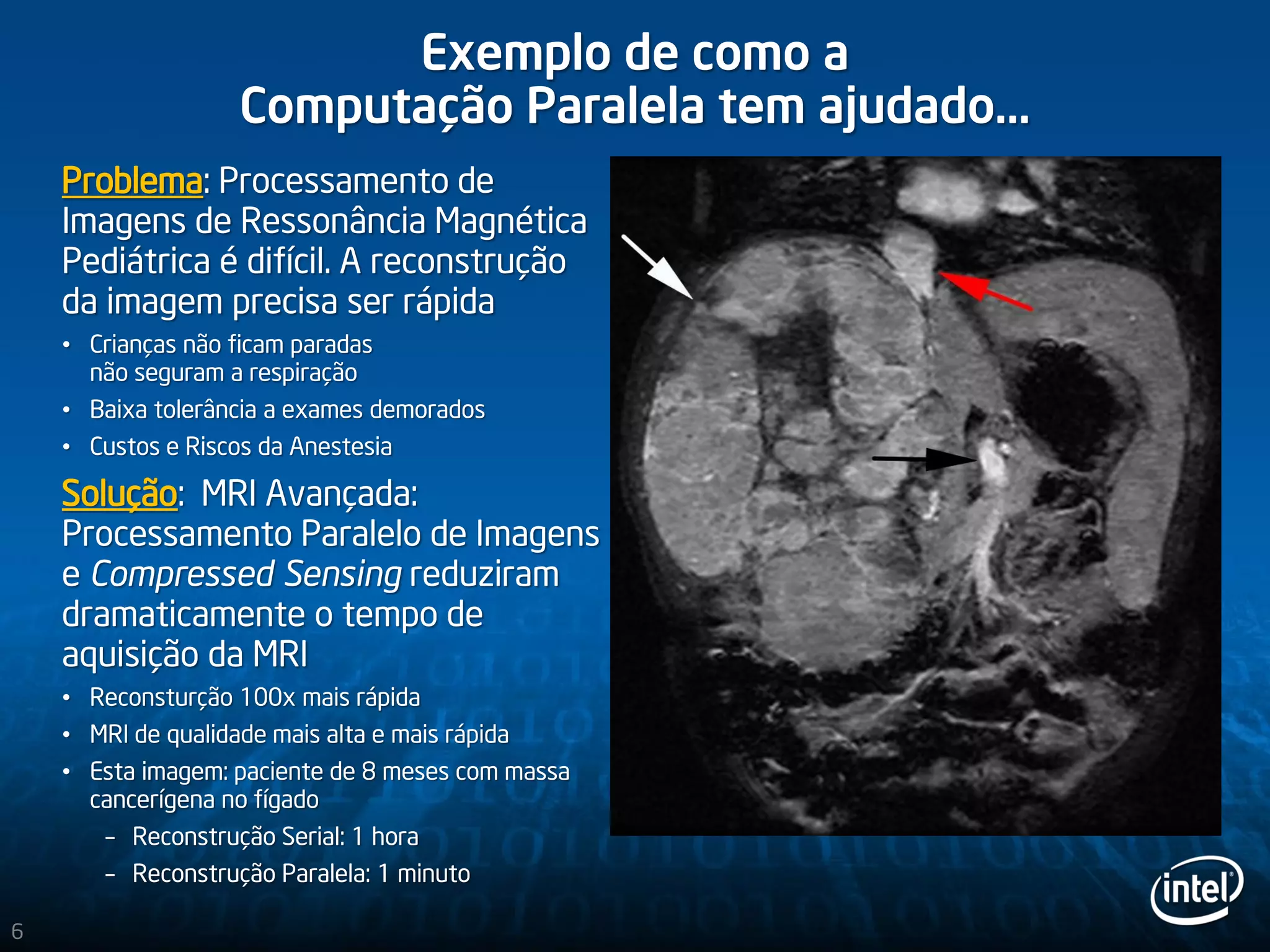 Exemplo de como a
Computação Paralela tem ajudado...
Problema: Processamento de
Imagens de Ressonância Magnética
Pediátrica é difícil. A reconstrução
da imagem precisa ser rápida
• Crianças não ficam paradas
não seguram a respiração
• Baixa tolerância a exames demorados
• Custos e Riscos da Anestesia
Solução: MRI Avançada:
Processamento Paralelo de Imagens
e Compressed Sensing reduziram
dramaticamente o tempo de
aquisição da MRI
• Reconsturção 100x mais rápida
• MRI de qualidade mais alta e mais rápida
• Esta imagem: paciente de 8 meses com massa
cancerígena no fígado
– Reconstrução Serial: 1 hora
– Reconstrução Paralela: 1 minuto
6
 