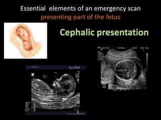 Essential elements of an emergency scan
presenting part of the fetus
 