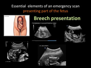 Essential elements of an emergency scan
presenting part of the fetus
 