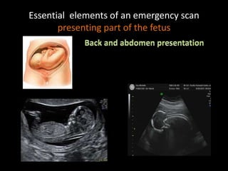 Essential elements of an emergency scan
presenting part of the fetus
 