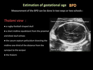 Thalami view :
● a rugby-football-shaped skull
● a short midline equidistant from the proximal
and distal skull echoes
● the cavum septum pellucidum bisecting the
midline one-third of the distance from the
synciput to the occiput
● the thalami
 