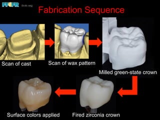 Fabrication Sequence
Scan of cast Scan of wax pattern
Milled green-state crown
Fired zirconia crownSurface colors applied
 