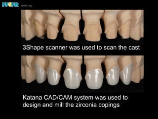 3Shape scanner was used to scan the cast
Katana CAD/CAM system was used to
design and mill the zirconia copings
 