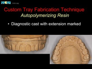Custom Tray Fabrication Technique
Autopolymerizing Resin
•  Diagnostic cast with extension marked
 