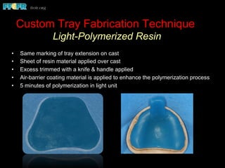 Custom Tray Fabrication Technique
Light-Polymerized Resin
•  Same marking of tray extension on cast
•  Sheet of resin material applied over cast
•  Excess trimmed with a knife & handle applied
•  Air-barrier coating material is applied to enhance the polymerization process
•  5 minutes of polymerization in light unit
 